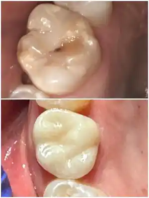 CEREC-Crown